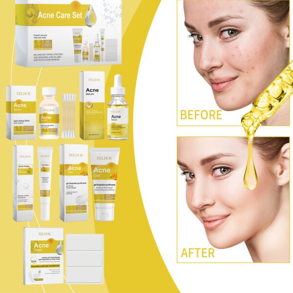 EELHOE Acne-prone Skin Care Set. Suitable for acne-prone skin care, it can make the skin tender, hydrate and moisturize the skin, and improve skin condition. - Image 2