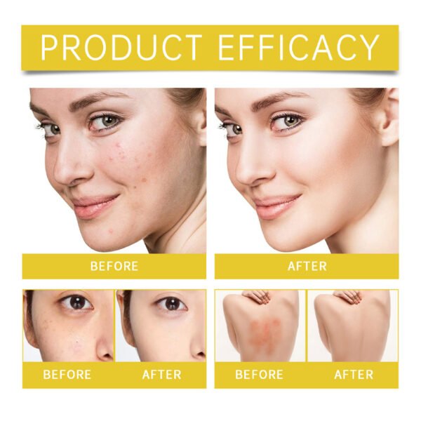 EELHOE Acne-prone Skin Care Set. Suitable for acne-prone skin care, it can make the skin tender, hydrate and moisturize the skin, and improve skin condition. - Image 7